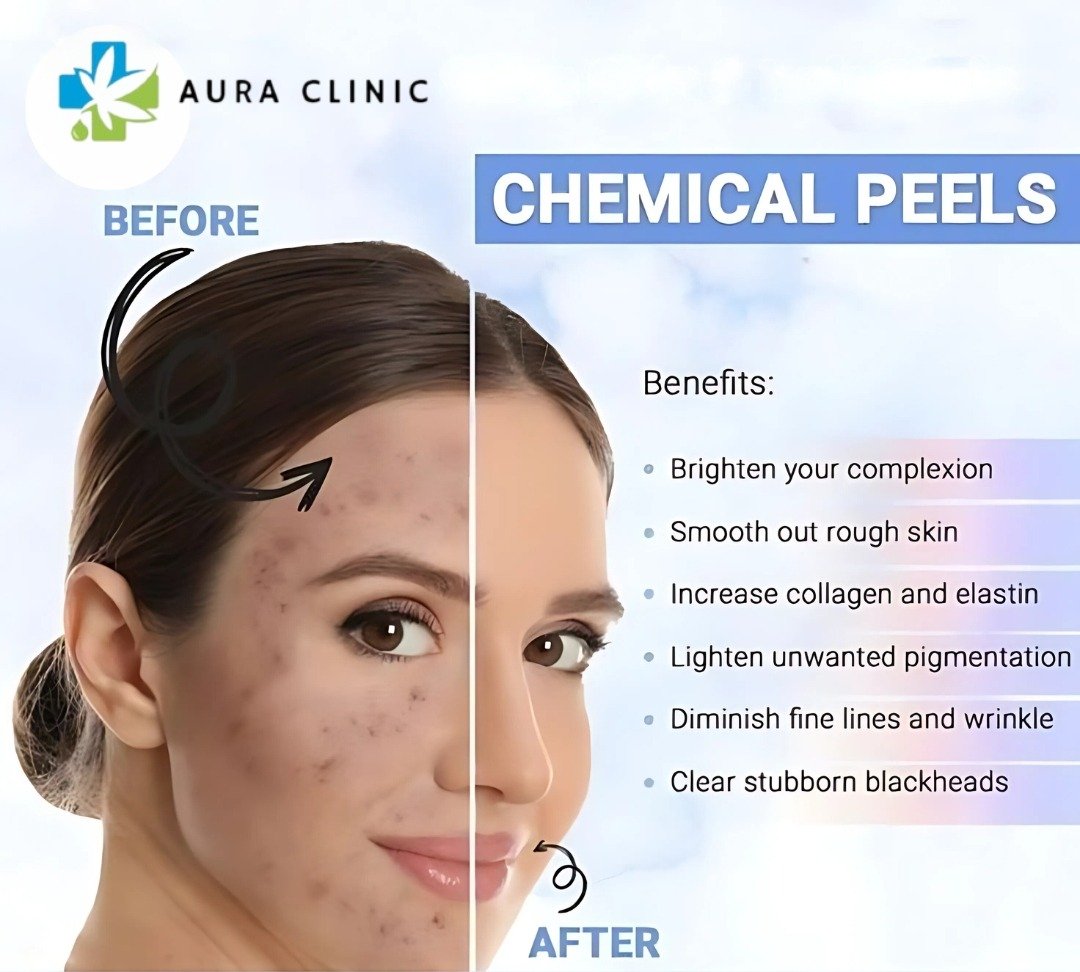 CHEMICAL PEELS